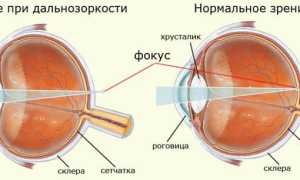 Причины дальнозоркости или гиперметропии: что нужно знать