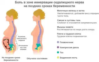 Боли в спине при беременности: причины и рекомендации