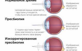 Пресбиопия – спутник наступающей старости, её причины и последствия