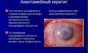Акантамебный кератит: причины, симптомы и лечение глазных заболеваний