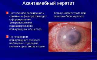 Акантамебный кератит: причины, симптомы и лечение глазных заболеваний