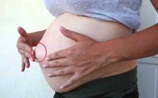 Пупочная грыжа при беременности: что делать для здоровья