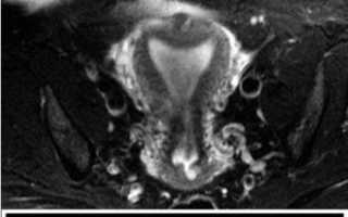 Патология при беременности: седловидная матка, возможно ли зачатие и последствия