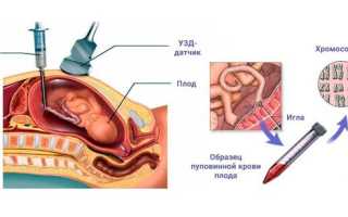 Многоводие — что это и как с этим бороться эффективно