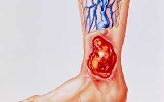 Трофическая язва на ноге: правильное лечение, народные средства, рецепты, видео