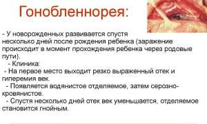 Глаза красные и гноятся – что делать, если чешутся и краснеют, советы врачей