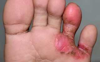 Аллергия кожи при микозе стоп