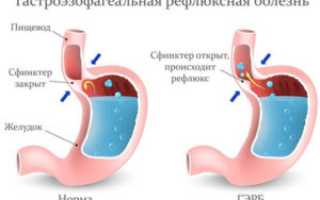 ГЭРБ при беременности: причины и лечение