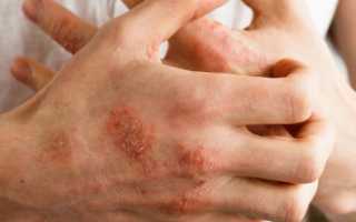 Что такое нейродермит и как его вылечить? Лечение, питание, видео