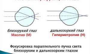 Гиперметропия – что это такое со зрением, что значит врожденная дальнозоркость у детей и как с ней справиться