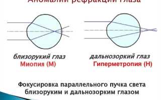 Гиперметропия – что это такое со зрением, что значит врожденная дальнозоркость у детей и как с ней справиться