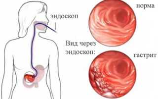 Хронический и острый гастрит у взрослых: симптомы, лечение и питание