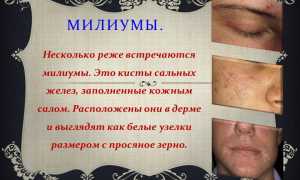 Милиумы – это, как избавиться, удалить и лечить: удаление и лечение кожи