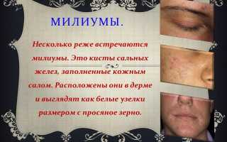 Милиумы – это, как избавиться, удалить и лечить: удаление и лечение кожи