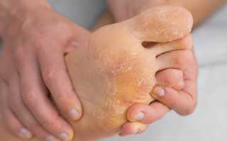 Микоз стоп и ладоней чем лечить