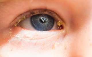 Гнойные выделения из глаз — правильное лечение, медицина и народные средства