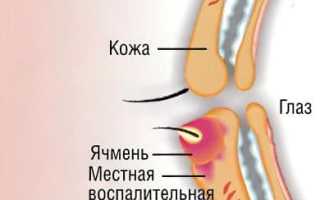 Как быстро избавиться от ячменя: медикаментозные и народные средства для здоровья