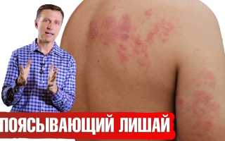 Натуральные средства от опоясывающего лишая — 7 простых средств + видео