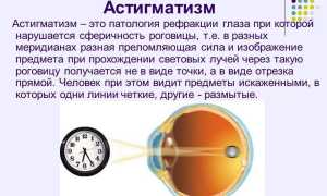 МКБ астигматизм миопический и смешанный – н52 диагноз для врачей