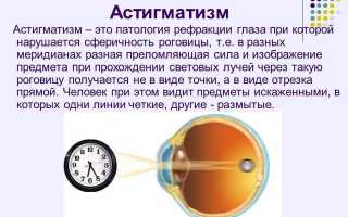 МКБ астигматизм миопический и смешанный – н52 диагноз для врачей