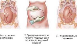 Предлежание плода при беременности: причины и последствия
