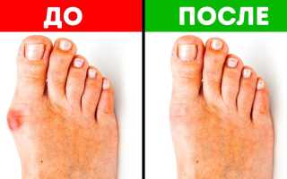 Шишки на ногах у большого пальца: способы лечения народными средствами, видео