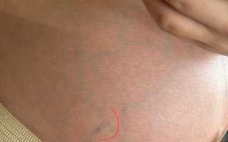 Почему просвечиваются вены на животе при беременности и что с этим делать