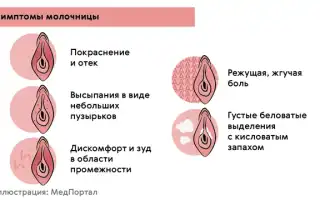 Как определить на какой стадии молочница