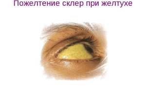 Желтые белки глаз: возможные причины патологии и лечение для здоровья