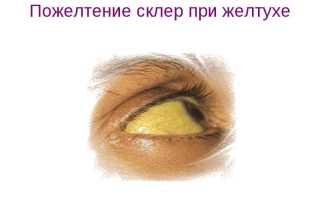 Желтые белки глаз: возможные причины патологии и лечение для здоровья
