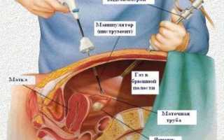Возьмут ли с молочницей на лапароскопию яичников