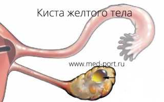 Киста желтого тела яичника — что это и как лечить
