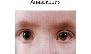 У ребенка разные зрачки по размеру – причины у новорожденного младенца и советы