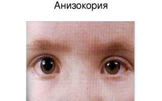 У ребенка разные зрачки по размеру – причины у новорожденного младенца и советы