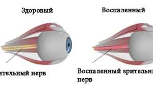 Заболевание “Неврит зрительного нерва”: симптомы и лечение, важные аспекты