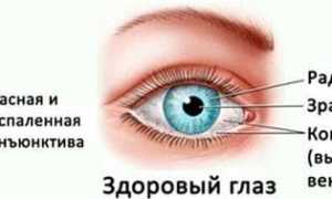 Конъюнктивит – капли глазные для лечения вирусного, аллергического и бактериального заболеваний глаз