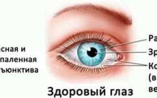 Конъюнктивит – капли глазные для лечения вирусного, аллергического и бактериального заболеваний глаз