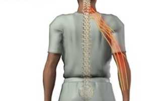 Радикулит шейного отдела: симптомы и лечение, видео — снятие боли, причины болезни