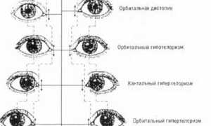 Что такое орбитальный гипертелоризм? Узнайте больше о его причинах и последствиях.
