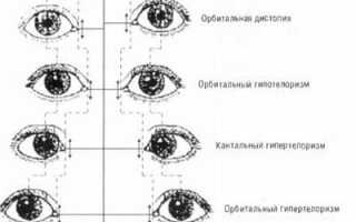 Что такое орбитальный гипертелоризм? Узнайте больше о его причинах и последствиях.