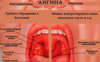 Ангина без температуры: гнойная и катаральная, симптомы, лечение