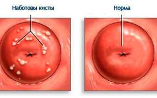 Кисты на шейке матки: лечение народными средствами, диагностика, видео — советы