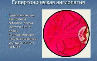 Как распознать и лечить артериальную гипертензию сетчатки: советы и рекомендации