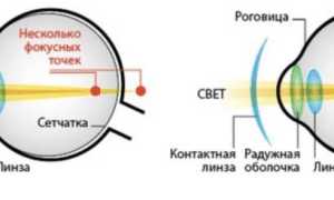 Как снять линзу контактную с глаза в первый раз, если не получается: полезные советы