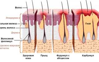 Фурункул при беременности — что делать и как помочь, советы врачей
