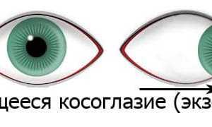 Причины возникновения и лечение расходящегося косоглазия у детей и взрослых