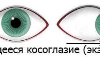 Причины возникновения и лечение расходящегося косоглазия у детей и взрослых