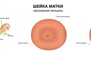 Как влияет короткая шейка матки при беременности на вынашивание плода и роды: важные аспекты