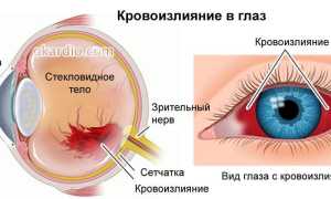 Кровоподтек в глазу: причины и лечение, от чего происходит, важные аспекты