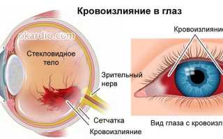 Кровоподтек в глазу: причины и лечение, от чего происходит, важные аспекты